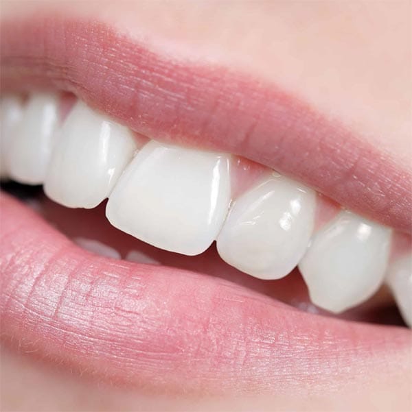 Carilles dentals composite