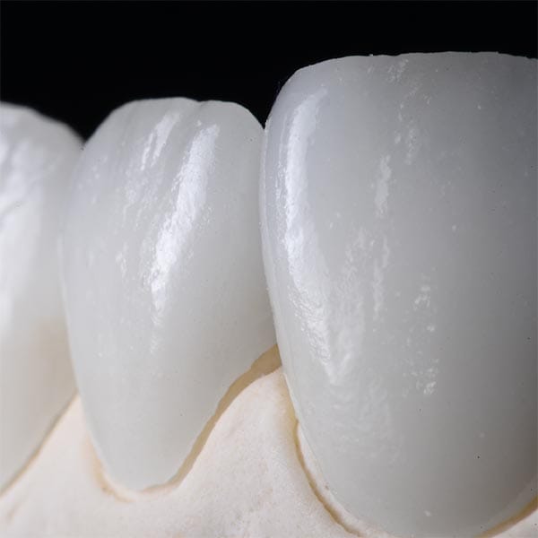 Carilles dentals de porcelana a Blanes girona