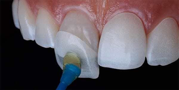 Colocació de carilles dentals a blanes Girona