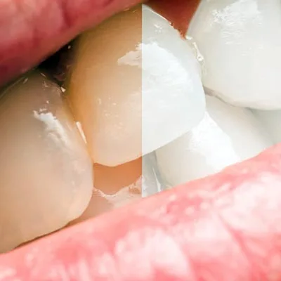 Enblanquiment dental de taques extrinseques exogenes a blanes girona Enblanquiment dental de taques extrinseques exogenes a blanes girona