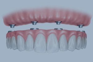 Protesi fixa sobre implantes blanes