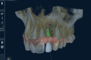 Escáner dental 3d