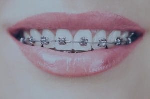 Ortodoncia brackets metalics blanes girona