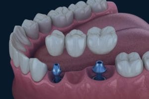 Implant dental