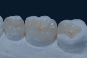 Reconstrucció i incrustracio dental