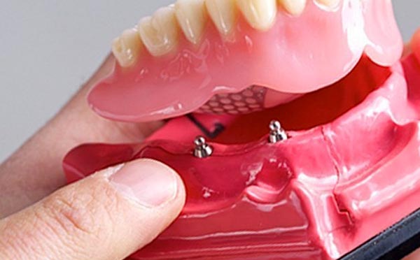 Dentadura fixa amb implants