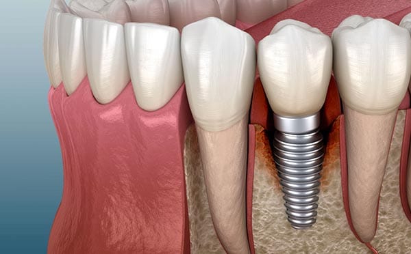 Implants per a dentadures fixes