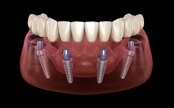 Dentadura fixa sobre implants