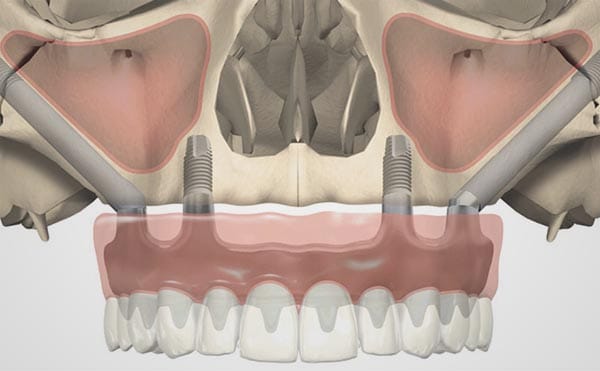 Implants zigomàtics arcada completa