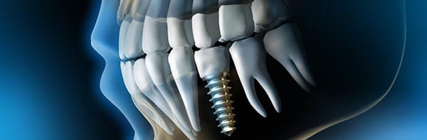 Implant o pont dental