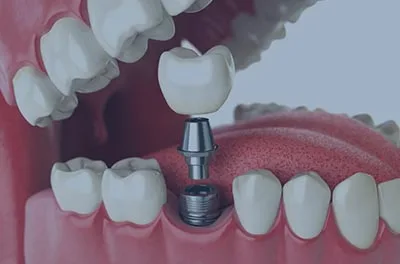 Implant dental blanes Implant dental blanes