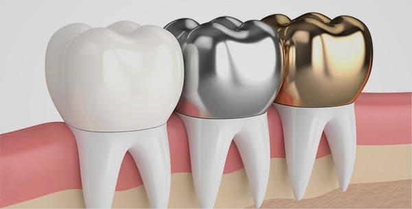 Corona dental metálica blanes girona