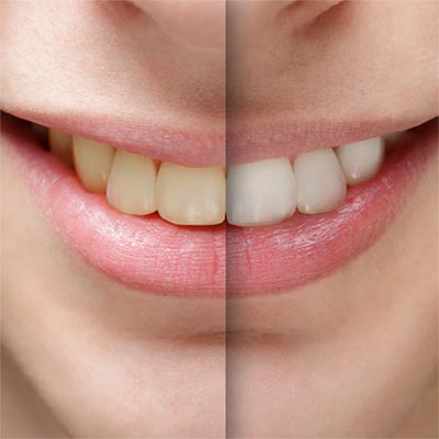 limpieza dental manchas intrinsecas endógenas blanes girona