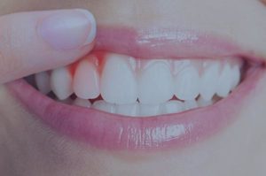Mantenimiento periodontal en blanes girona