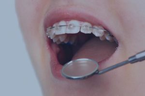 Ortodoncia infantil en blanes girona