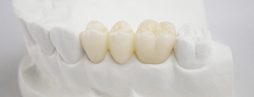 Corona dental zirconio blanes