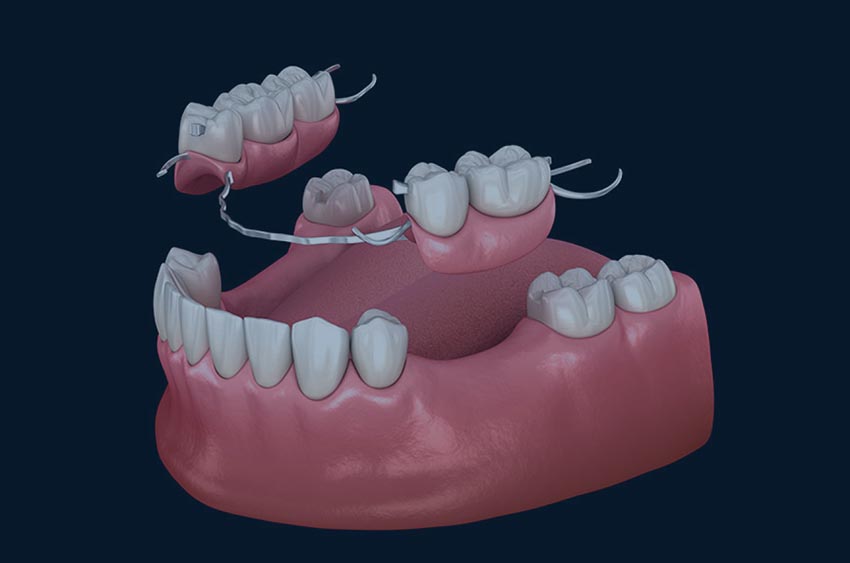 Puente dental removible