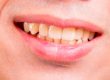 Cuanto dura un blanqueamiento dental