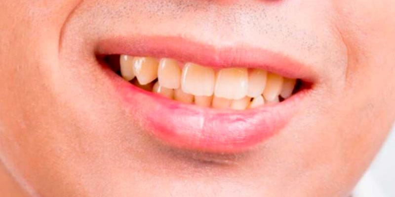 Cuanto dura un blanqueamiento dental Cuanto dura un blanqueamiento dental