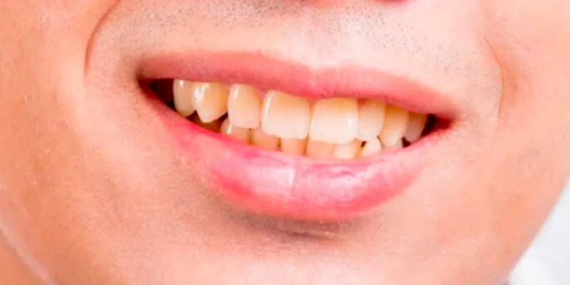 Cuanto dura un blanqueamiento dental