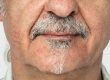 Cuanto tiempo dura un implante dental