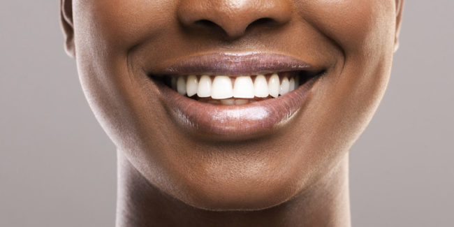 peroxido de carbamida blanqueamiento dental