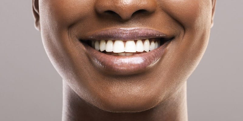 peroxido de carbamida blanqueamiento dental peroxido de carbamida blanqueamiento dental