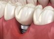¿Qué es la preiimplantitis?