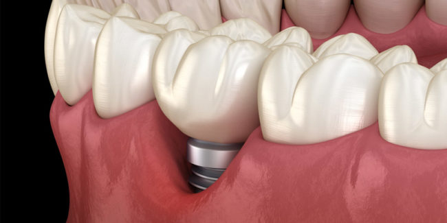 ¿Qué es la preiimplantitis? ¿Qué es la preiimplantitis?