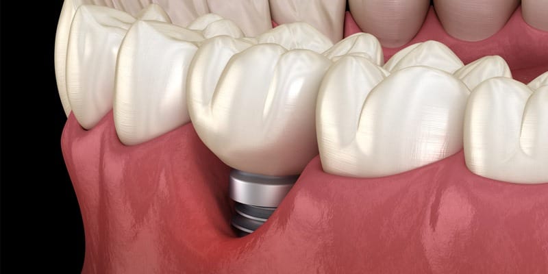 ¿Qué es la preiimplantitis? ¿Qué es la preiimplantitis?