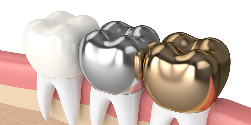 Qué es mejor una corona dental metálica o una corona dental