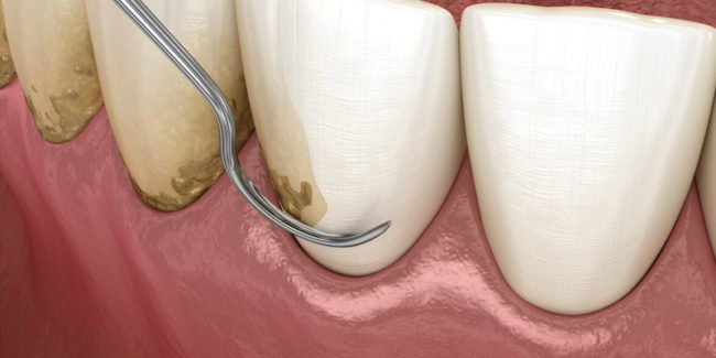Que es el raspado y alisado radicular