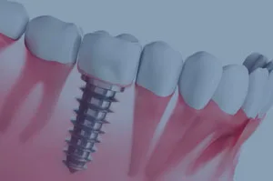 Cirugía de implantes Cirugía de implantes