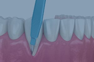 Cirugía periodontal