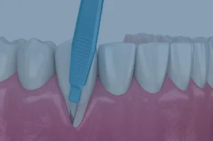 Cirugía periodontal Cirugía periodontal