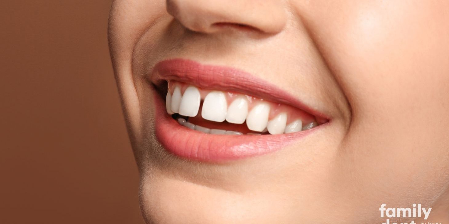 espacios-entre-dientes-carillas-dentales