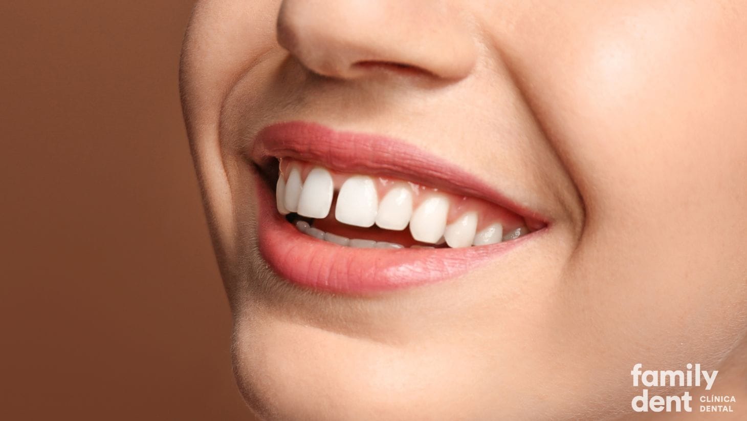 espacios-entre-dientes-carillas-dentales espacios-entre-dientes-carillas-dentales