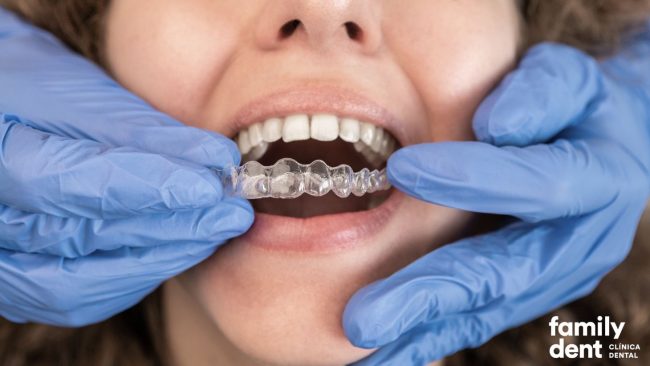 guia-ortodoncia-invisible-invisalign guia-ortodoncia-invisible-invisalign