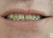dientes-con-manchas-por-tetraciclinas