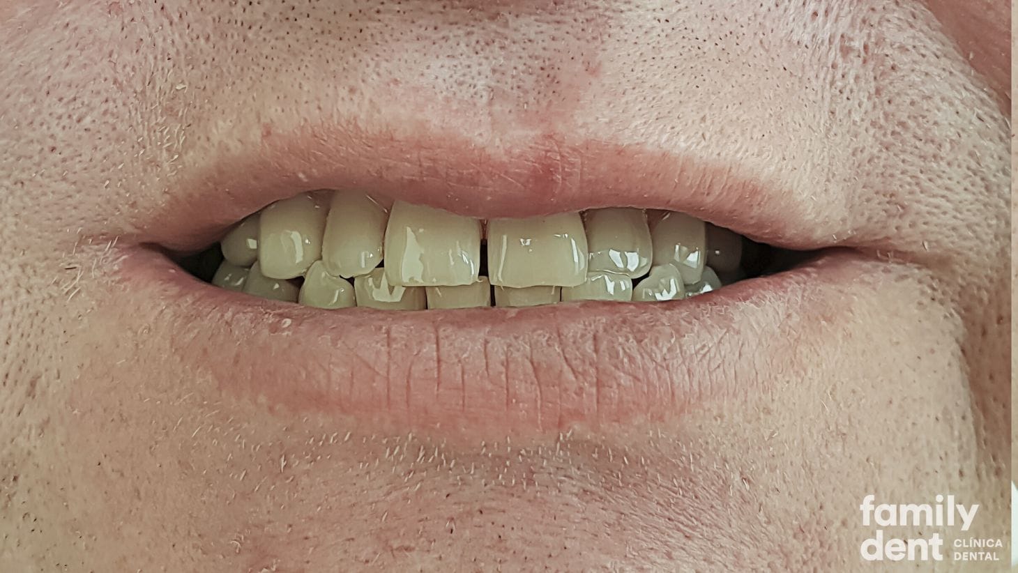 dientes-con-manchas-por-tetraciclinas dientes-con-manchas-por-tetraciclinas