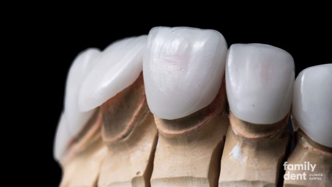Carillas para tratar la periodontitis