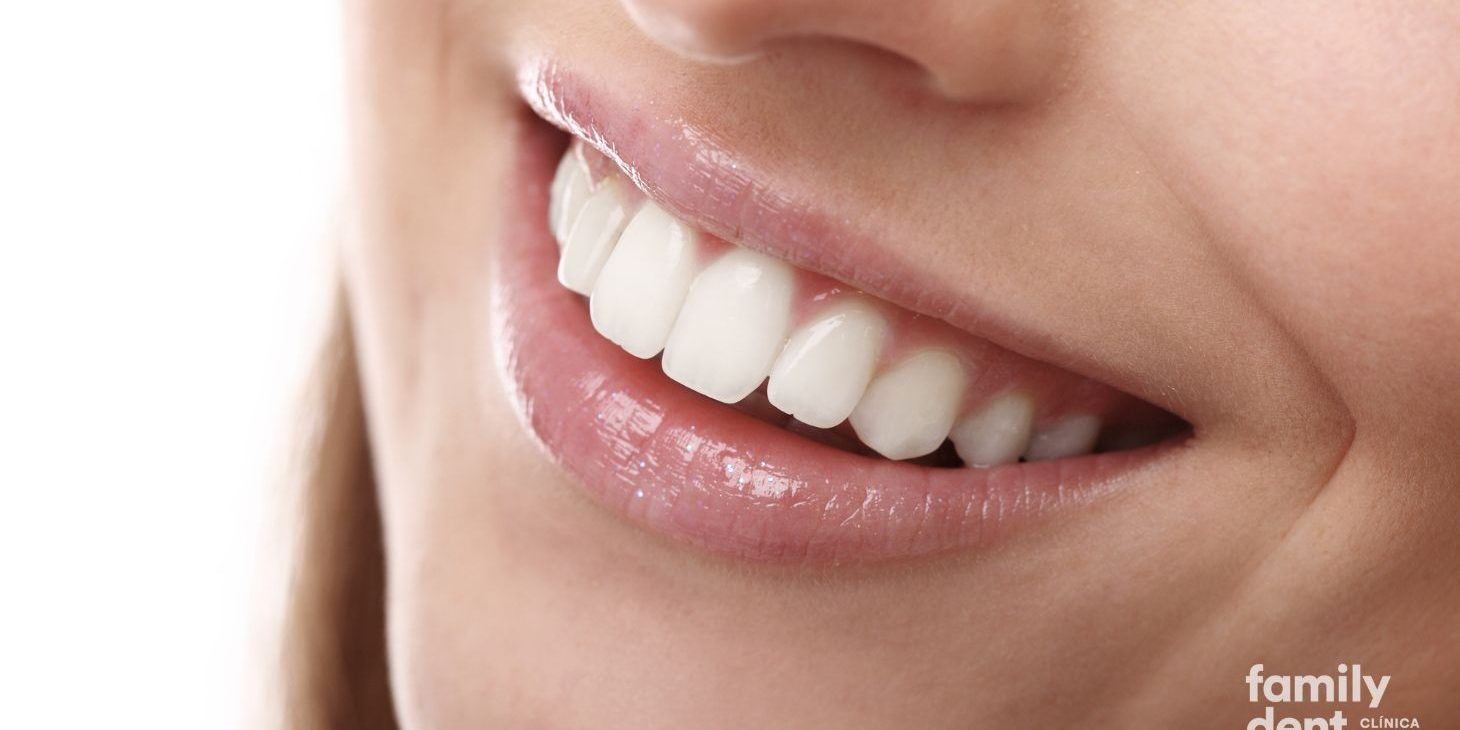 FAMILY – Tratamiento sonrisa gingival Tratamiento sonrisa gingival