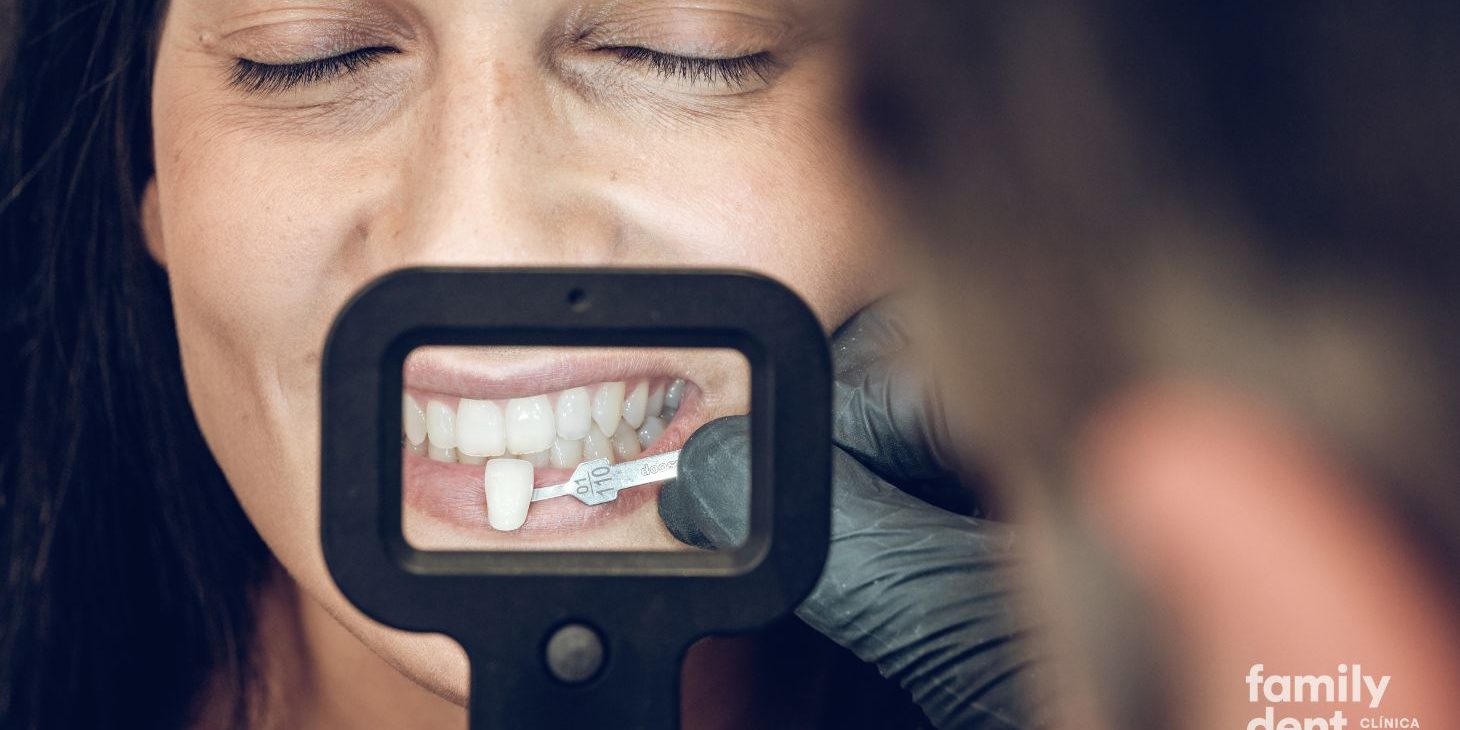 FAMILY – Diseño de sonrisas con carillas dentales Diseño de sonrisas con carillas dentales