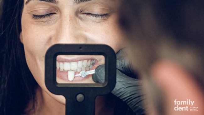 FAMILY – Diseño de sonrisas con carillas dentales Diseño de sonrisas con carillas dentales