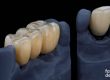 Puentes dentales