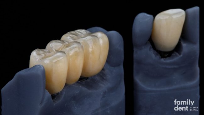 FAMILY – Puentes dentales Puentes dentales