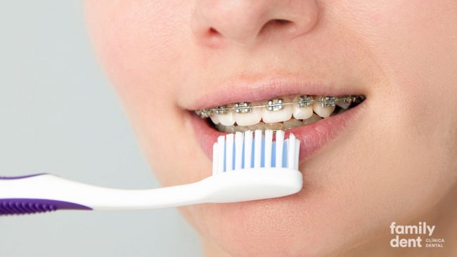FAMILY – Ortodoncia para Adolescentes Ortodoncia para Adolescentes