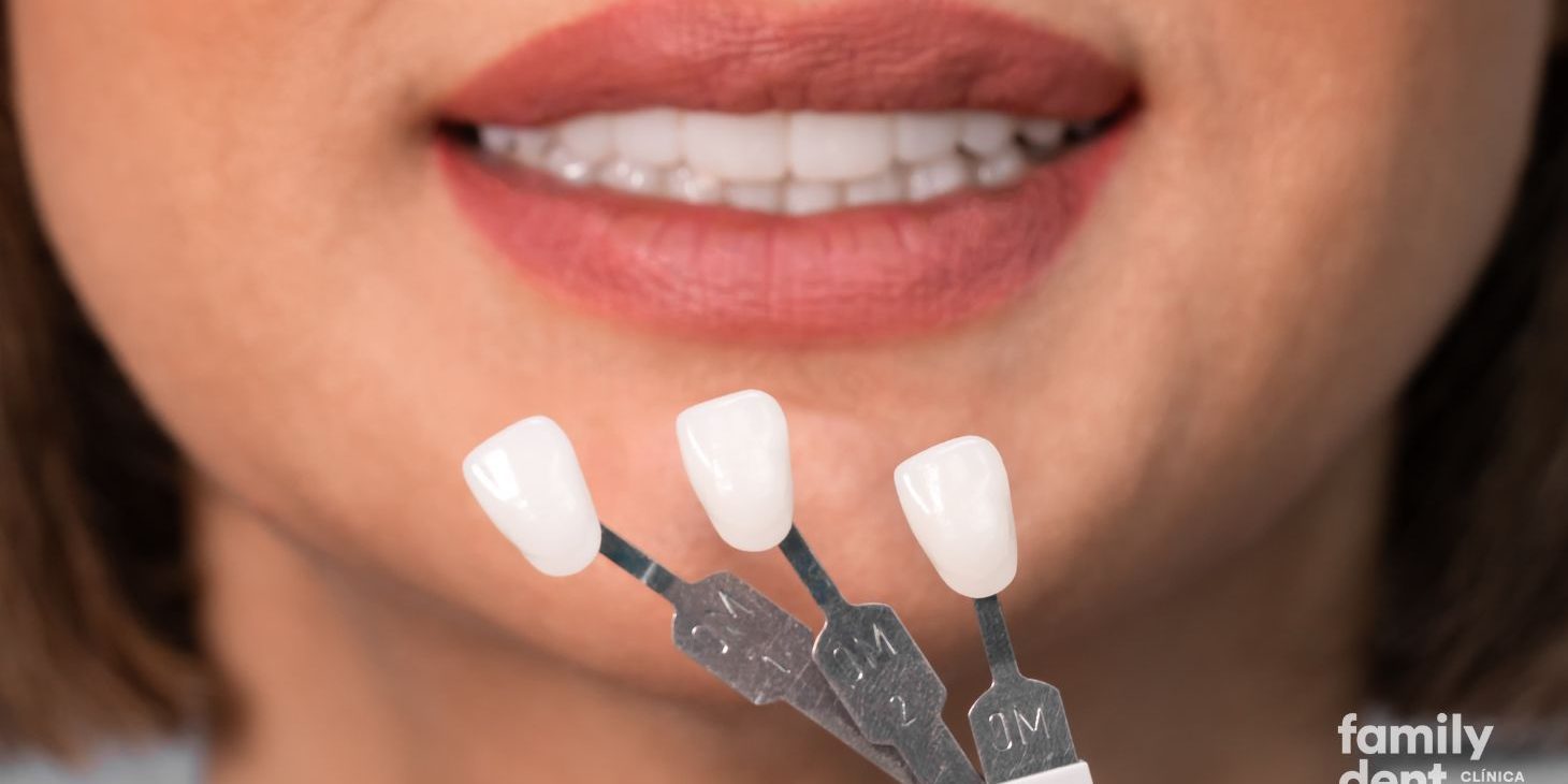 FAMILY – Carillas composite Carillas composite