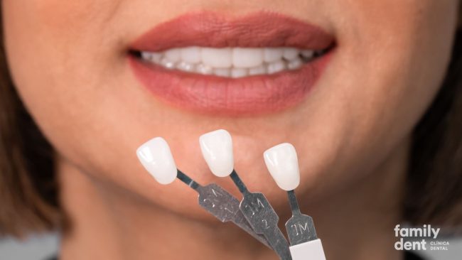 FAMILY – Carillas composite Carillas composite