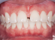 Carillas para Espacios entre Dientes